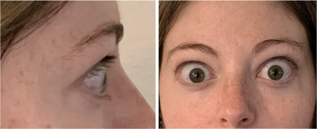 PatientResults_Slider03_Patient_01_Infusion04