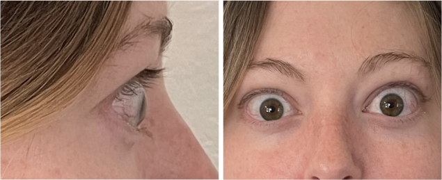 PatientResults_Slider03_Patient_01_Infusion05