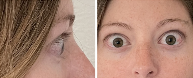 PatientResults_Slider03_Patient_01_Infusion06