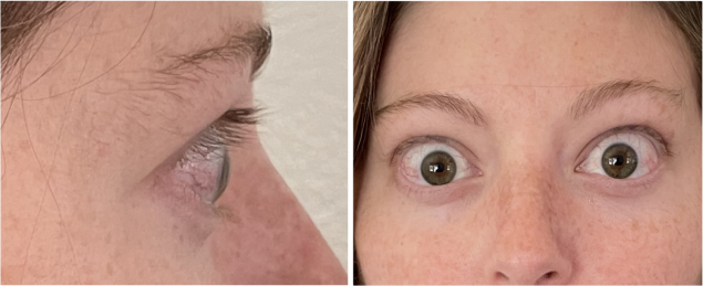 PatientResults_Slider03_Patient_01_Infusion07