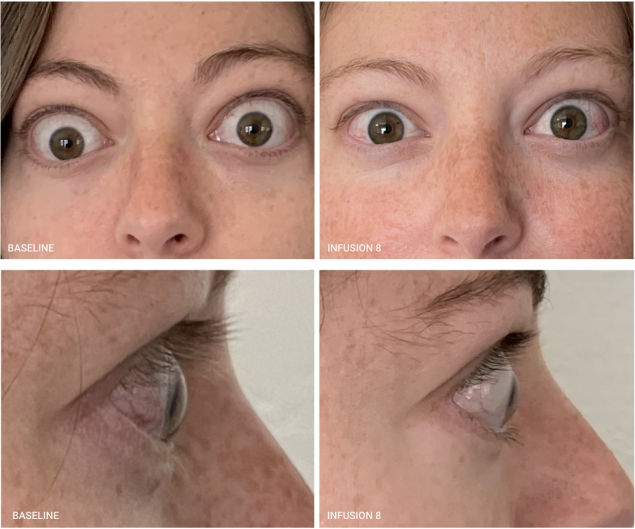 PatientResults_Slider03_Patient_01_Infusion08_Comparison