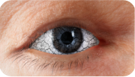 dry-eyes